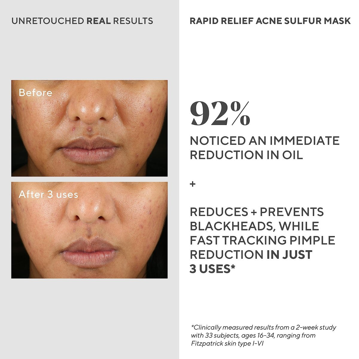 Murad Rapid Relief Acne Sulfur Mask – 2.5 oz Clay Mask with Salicylic Acid, 5% Sulfur & Austrian Peat to Reduce Oil, Minimize Breakouts & Unclog Pores Avelisse
