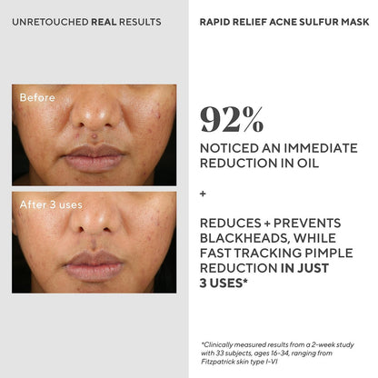 Murad Rapid Relief Acne Sulfur Mask – 2.5 oz Clay Mask with Salicylic Acid, 5% Sulfur & Austrian Peat to Reduce Oil, Minimize Breakouts & Unclog Pores Avelisse