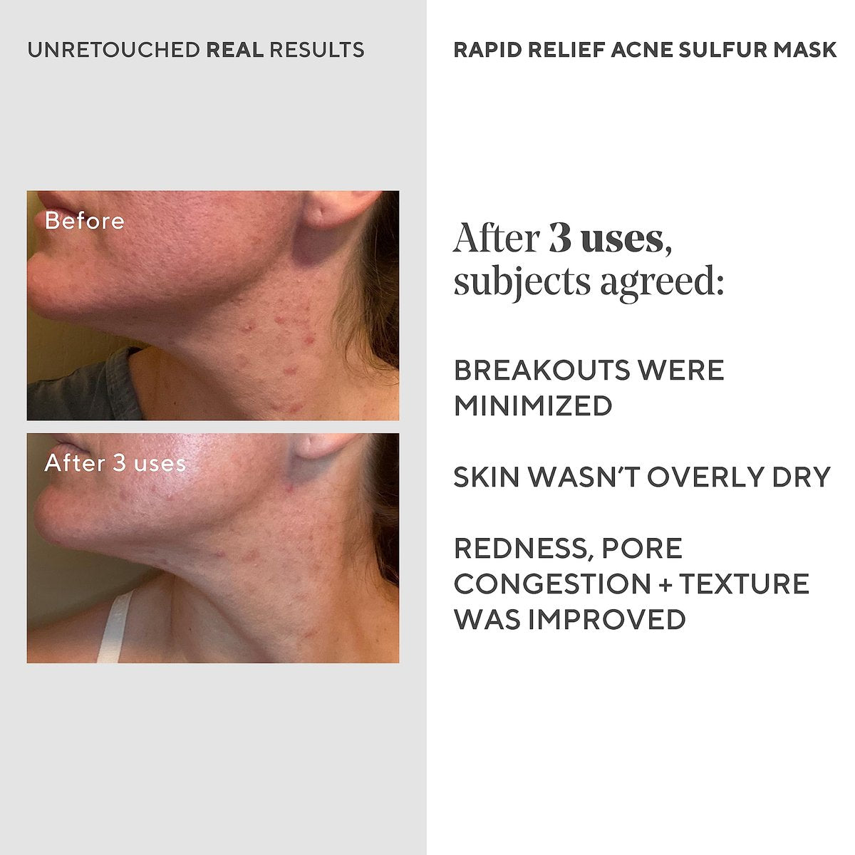 Murad Rapid Relief Acne Sulfur Mask – 2.5 oz Clay Mask with Salicylic Acid, 5% Sulfur & Austrian Peat to Reduce Oil, Minimize Breakouts & Unclog Pores Avelisse