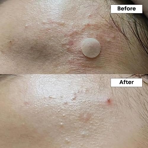 NINELESS A-Control 10% Azelaic Acid Serum – Clarifying & Smoothing Face Serum Avelisse
