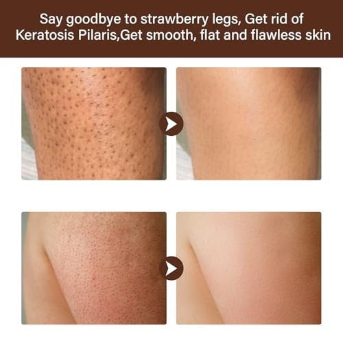 YAFUSIPE Strawberry Legs Treatment - Niacinamide Resurfacing Cream for Keratosis Pilaris, Hydrating Body Moisturizer for Women & Men, 4.2 Fl Oz Avelisse