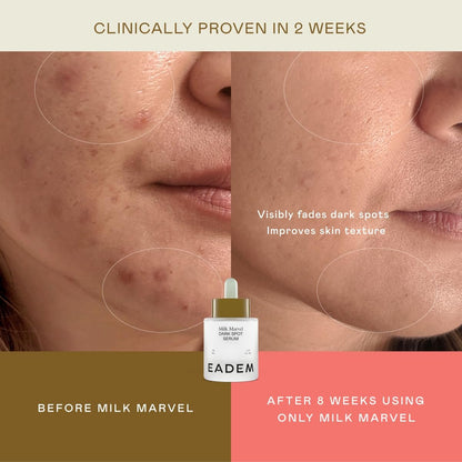 EADEM Milk Marvel Dark Spot Serum – Vitamin C & Niacinamide Face Serum for Dark Spot Removal, Natural Skin Care, 1 oz Avelisse