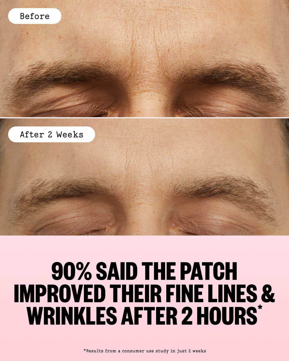 PEACE OUT Microneedling Wrinkle Patches with Retinol, Peptides & Vitamin C - 6 Count Avelisse