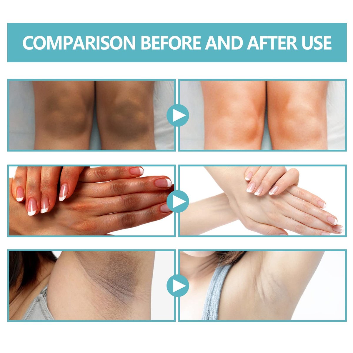 Nigrifix Acanthosis Nigricans Therapy Cream – Dark Spot Remover for Body, Underarm, Neck, Armpit, Knees, Elbows, Private Areas – Upgraded Formula, 2.1 Fl Oz Avelisse