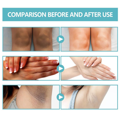 Nigrifix Acanthosis Nigricans Therapy Cream – Dark Spot Remover for Body, Underarm, Neck, Armpit, Knees, Elbows, Private Areas – Upgraded Formula, 2.1 Fl Oz Avelisse