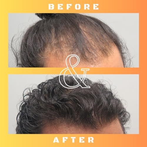 Mane Regain RU58841 5% Solution (50mg/ml) - DHT Blocker - Advanced Hair Loss Treatment - Anti-Androgen Hair Tonic - Promotes Hair Regrowth and Prevents Male Pattern Baldness - 30ml Avelisse