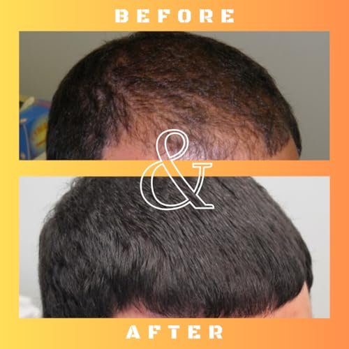 Mane Regain RU58841 5% Solution (50mg/ml) - DHT Blocker - Advanced Hair Loss Treatment - Anti-Androgen Hair Tonic - Promotes Hair Regrowth and Prevents Male Pattern Baldness - 30ml Avelisse