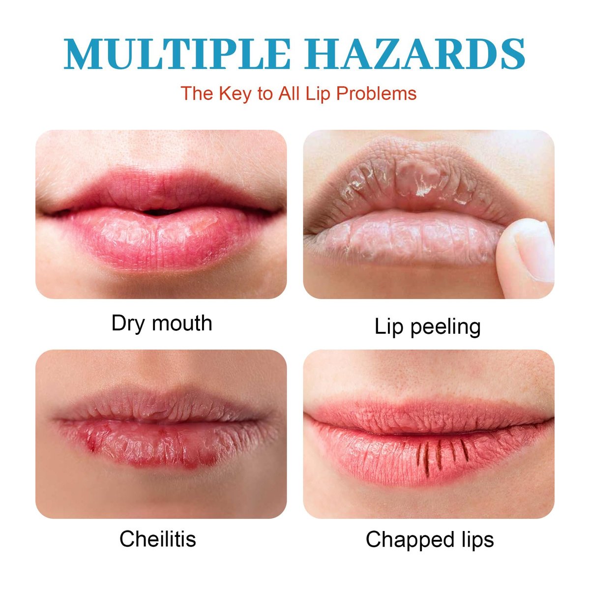 Dry Cracked Lips - Natural Healing Lip Balm, Organic All-Day Moisture Cheilitis Treatment Cream - Men, Women & Children, Dermatologist Recommended - görsel 9