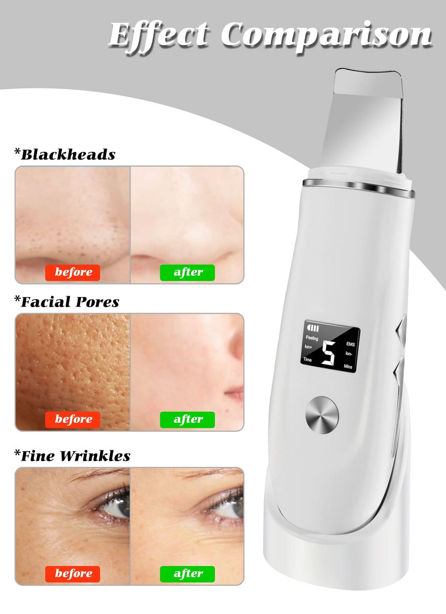 Ysxuan 4-in-1 Skin Scrubber Face Spatula – Blackhead Remover & Pore Cleaner with USB Charger (White, 5-Piece Set) Avelisse