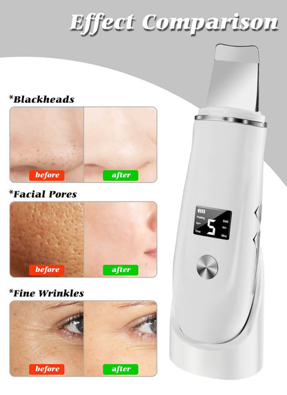 Ysxuan 4-in-1 Skin Scrubber Face Spatula – Blackhead Remover & Pore Cleaner with USB Charger (White, 5-Piece Set) Avelisse