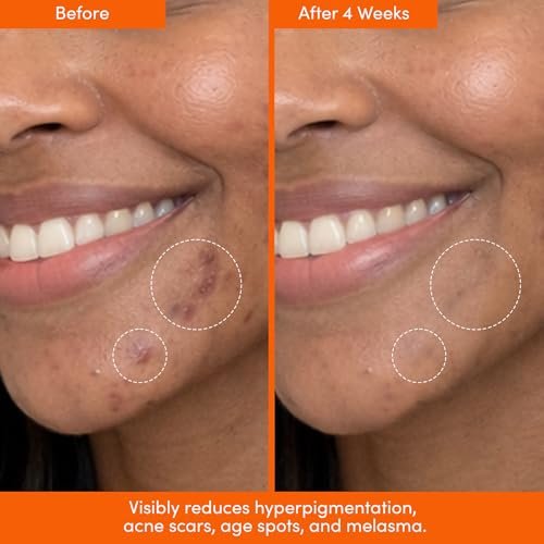 LION POSE UNSPOTTED 4X Dark Spot Correction Serum for Face and Body - Exfoliating AHA Serum with Azelaic, Glycolic, Lactic & Tranexamic Acids - Age & Sun Spot Remover, 1oz Avelisse