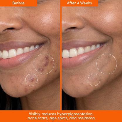 LION POSE UNSPOTTED 4X Dark Spot Correction Serum for Face and Body - Exfoliating AHA Serum with Azelaic, Glycolic, Lactic & Tranexamic Acids - Age & Sun Spot Remover, 1oz Avelisse