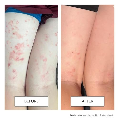 Untoxicated Moisturizing Cream - Face & Body Moisturizer for Sensitive Skin, NEA Approved for Eczema Relief, with Ceramides & Hyaluronic Acid, No Common Irritants, 10 Fl Oz Avelisse