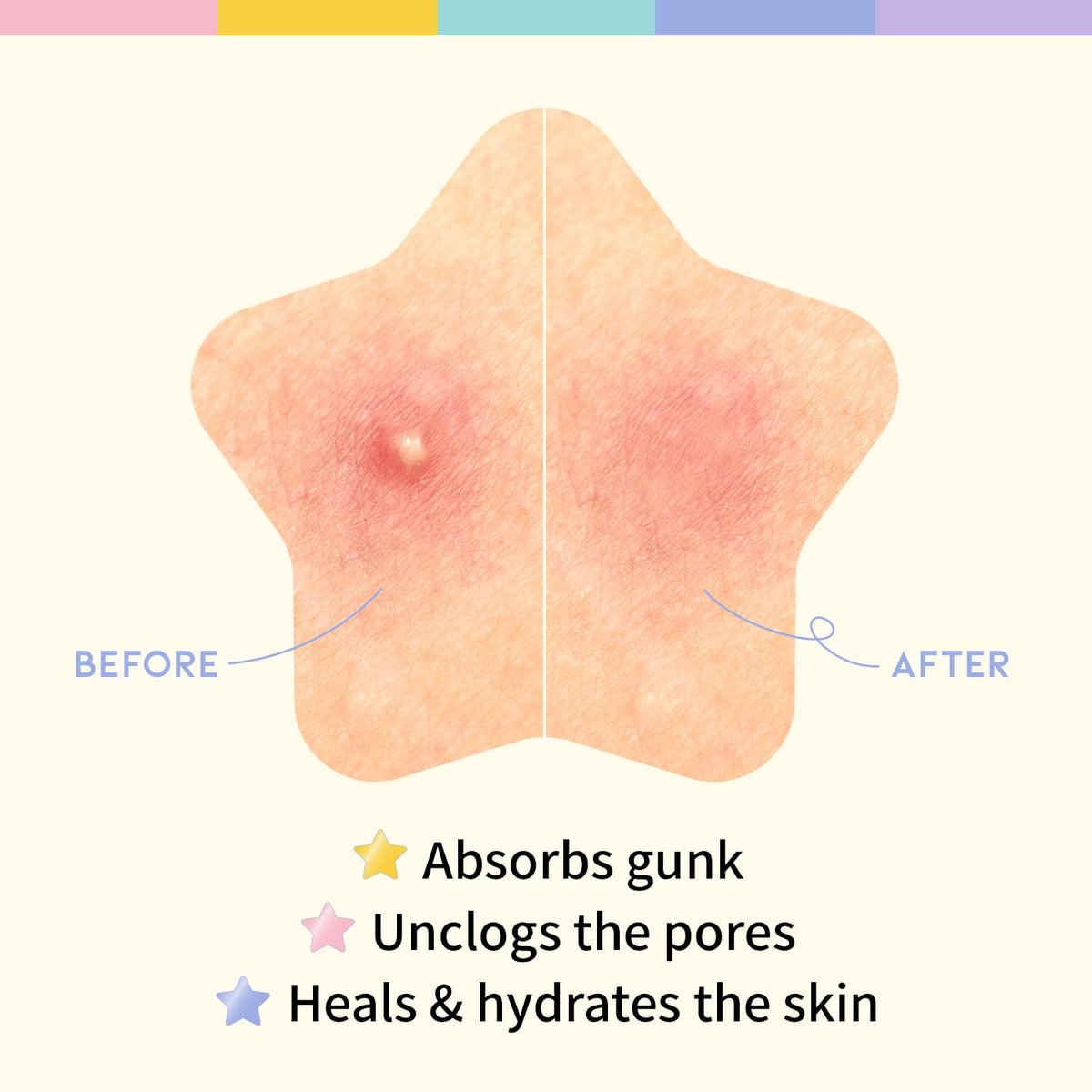 #OOTD Star Pimple Patches – Hydrocolloid Acne Spot Treatment with Niacinamide & Ceramide, Cute Pastel Colors, K-Beauty Skincare for Face, 80 Count Avelisse