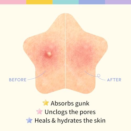 #OOTD Star Pimple Patches – Hydrocolloid Acne Spot Treatment with Niacinamide & Ceramide, Cute Pastel Colors, K-Beauty Skincare for Face, 80 Count Avelisse