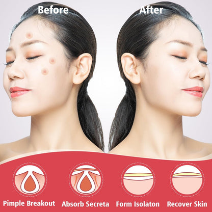 450 Pimple Patches for Face, Hydrocolloid Acne Patches, Invisible Zit Covers, 4 Sizes