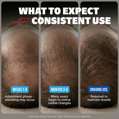 Kirkland Minoxidil Liquid Extra Strength Hair Regrowth Treatment for Men, 5% Topical Solution, 6 Months Supply with Dropper Applicator and Bonus Guide Avelisse