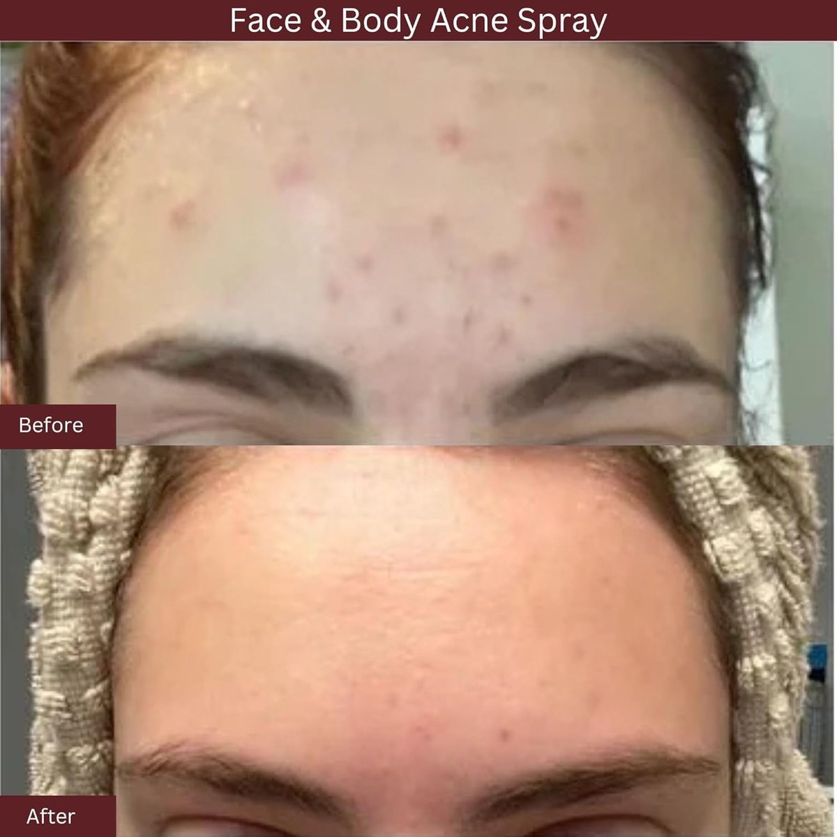 ITK Skincare 2% Salicylic Acid Spray for Face & Body Acne - Blemish-Fighting Treatment for Body Acne, Bacne, Blackheads, Pimples & Blemishes - BHA Blemish Facial Mist Post Workout - 3.3oz Spray Bottle - görsel 6