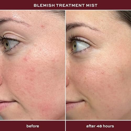 ITK Skincare 2% Salicylic Acid Spray for Face & Body Acne - Blemish-Fighting Treatment for Body Acne, Bacne, Blackheads, Pimples & Blemishes - BHA Blemish Facial Mist Post Workout - 3.3oz Spray Bottle - görsel 3
