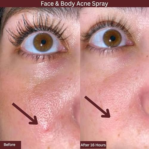 ITK Skincare 2% Salicylic Acid Spray for Face & Body Acne - Blemish-Fighting Treatment for Body Acne, Bacne, Blackheads, Pimples & Blemishes - BHA Blemish Facial Mist Post Workout - 3.3oz Spray Bottle - görsel 7