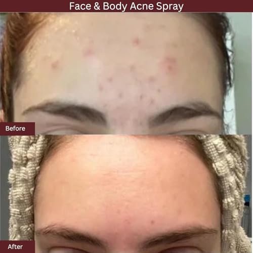 ITK Skincare 2% Salicylic Acid Spray for Face & Body Acne - Blemish-Fighting Treatment for Body Acne, Bacne, Blackheads, Pimples & Blemishes - BHA Blemish Facial Mist Post Workout - 3.3oz Spray Bottle - görsel 5