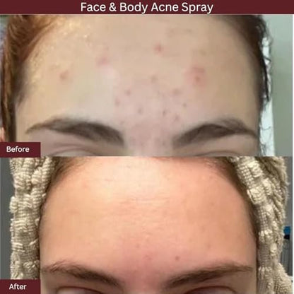 ITK Skincare 2% Salicylic Acid Spray for Face & Body Acne - Blemish-Fighting Treatment for Body Acne, Bacne, Blackheads, Pimples & Blemishes - BHA Blemish Facial Mist Post Workout - 3.3oz Spray Bottle