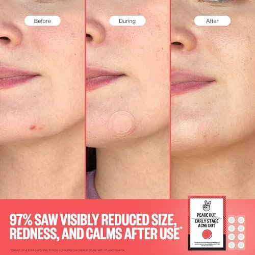 PEACE OUT Early Stage Acne Dots – Microneedling Pimple Patches with 2% Salicylic Acid for Blemishes Below Surface (8 Count) Avelisse