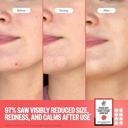 PEACE OUT Early Stage Acne Dots – Microneedling Pimple Patches with 2% Salicylic Acid for Blemishes Below Surface (8 Count) Avelisse