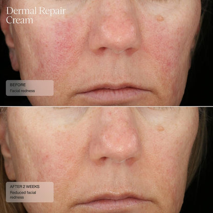 Senté Dermal Repair Facial Cream – Nourishing Moisturizer for Rosacea, Sensitive Skin & Post-Procedure, with Patented HSA, Vitamin E & Green Tea Extract, 1.7 Fl Oz Avelisse