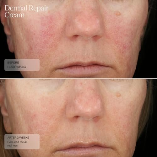Senté Dermal Repair Facial Cream – Nourishing Moisturizer for Rosacea, Sensitive Skin & Post-Procedure, with Patented HSA, Vitamin E & Green Tea Extract, 1.7 Fl Oz Avelisse