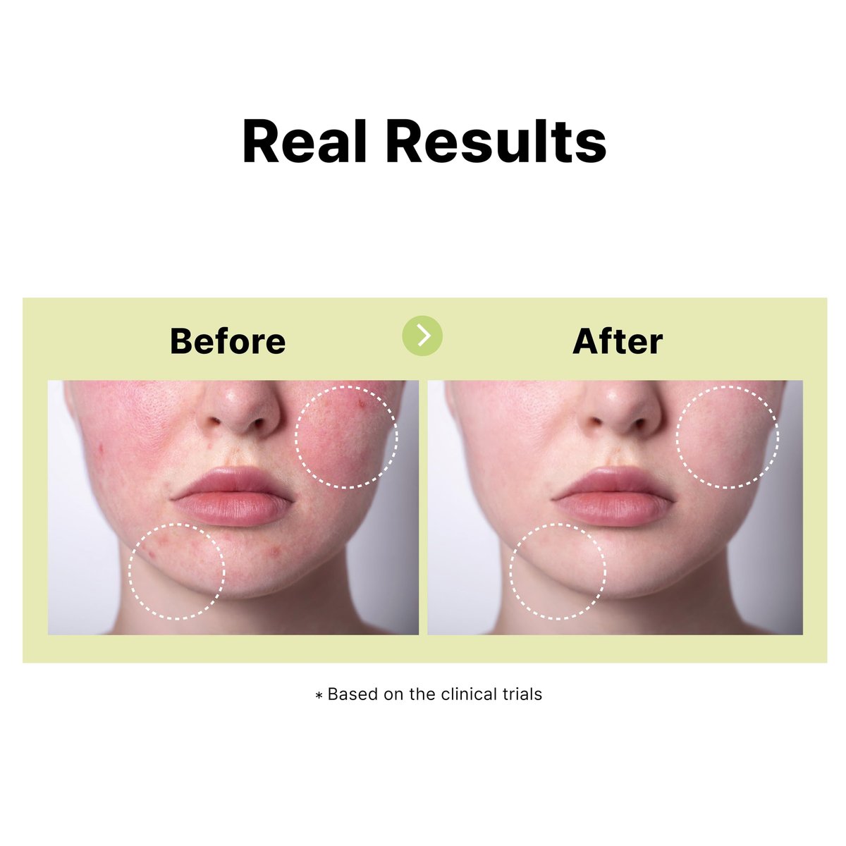 DearMYDEW 10% Azelaic Acid Serum with Niacinamide, Salicylic Acid, Allantoin – Rosacea & Redness Relief, Reduce Cystic Acne Scars & Pimples, Non-Comedogenic Korean Skincare, 1 Fl Oz Avelisse