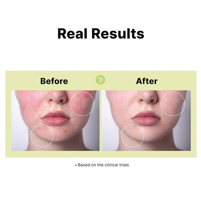 DearMYDEW 10% Azelaic Acid Serum with Niacinamide, Salicylic Acid, Allantoin – Rosacea & Redness Relief, Reduce Cystic Acne Scars & Pimples, Non-Comedogenic Korean Skincare, 1 Fl Oz Avelisse