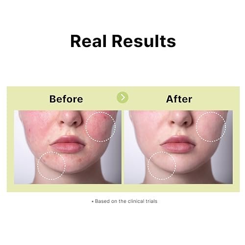 DearMYDEW 10% Azelaic Acid Serum with Niacinamide, Salicylic Acid, Allantoin – Rosacea & Redness Relief, Reduce Cystic Acne Scars & Pimples, Non-Comedogenic Korean Skincare, 1 Fl Oz Avelisse