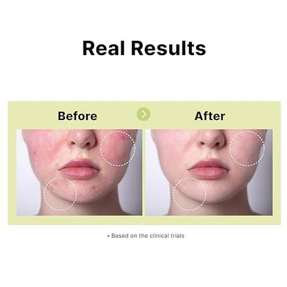 DearMYDEW 10% Azelaic Acid Serum with Niacinamide, Salicylic Acid, Allantoin – Rosacea & Redness Relief, Reduce Cystic Acne Scars & Pimples, Non-Comedogenic Korean Skincare, 1 Fl Oz Avelisse