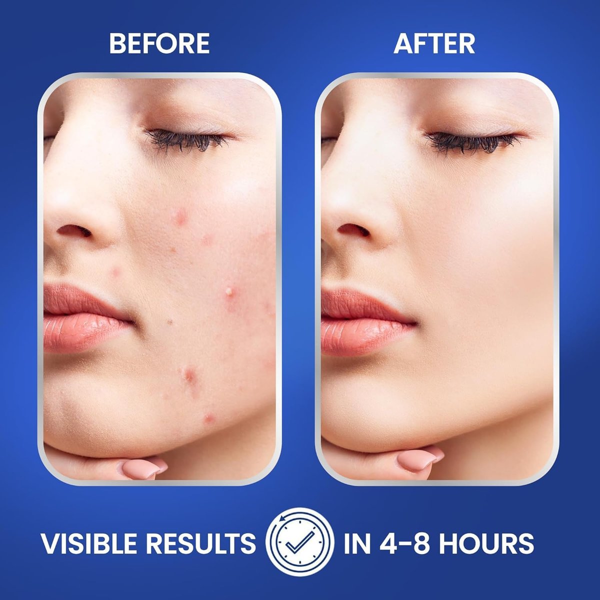 ZITLABS Pimple Patches for Face - Hydrocolloid Acne Patches with Tea Tree Oil & Salicylic Acid - Overnight PM Patches for Zits, Blemishes, Breakouts - Medical-Grade Hydrocolloid - Pack of 72 - görsel 15