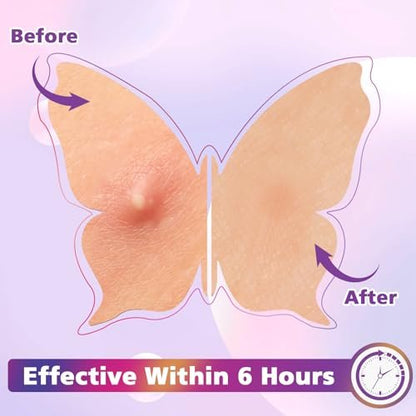 KONEUK Acne Pimple Patches for Face (160 Counts) - Hydrocolloid Acne Patches with Tea Tree Oil and Calendula Extract, Cute Colorful Butterfly Shape Spot Stickers for Skin Care