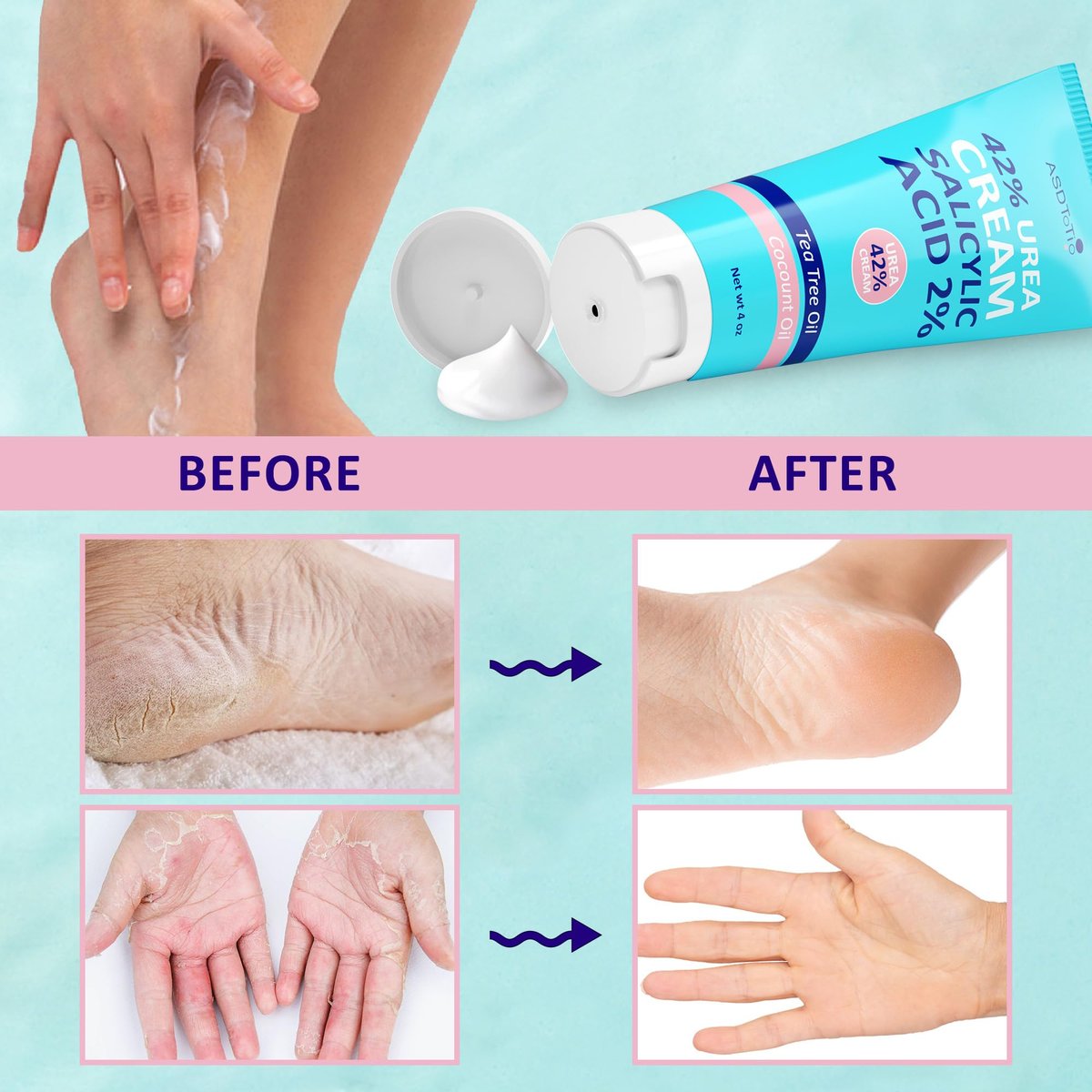 ASDToTio Urea Cream 42% - Intensive Foot Care for Dry Cracked Heels with 2% Salicylic Acid, Tea Tree Oil, Shea Butter & Aloe Vera - 4 oz - görsel 14