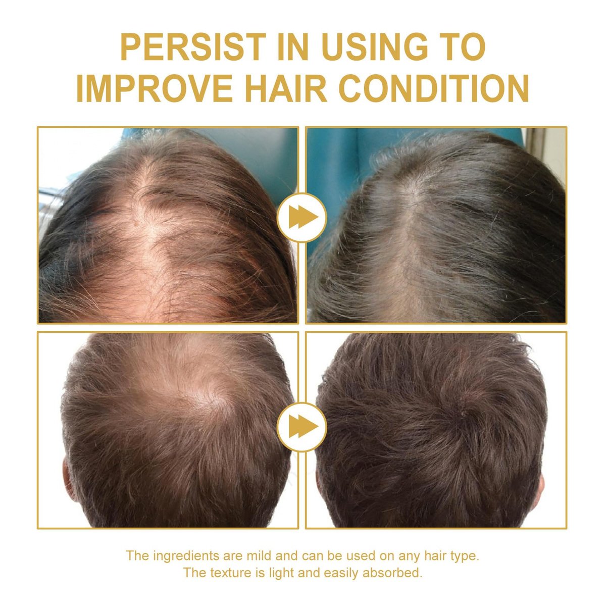 180 ML EELHOE Hair Growth Oil – Natural Rosemary Hair Oil for Dry, Damaged & Thinning Hair (3-Pack) Avelisse