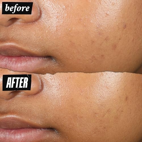 Kiehl's Truly Targeted Acne-Clearing Pimple Patch with 2% Salicylic Acid, Invisible Liquid Spot Treatment, 4% Niacinamide & 0.2% Licorice Root - 0.5 fl oz Avelisse