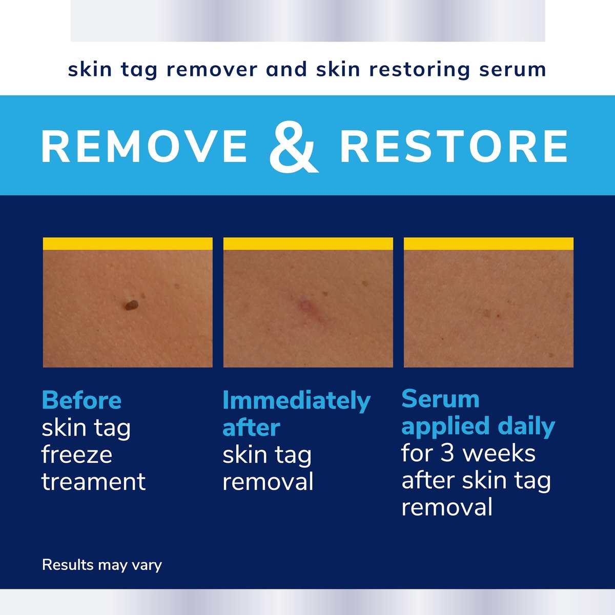 Dr. Scholl's Complete Care Skin Tag Remover Kit, 12 Treatments + Serum – Fast & Permanent Removal - görsel 9