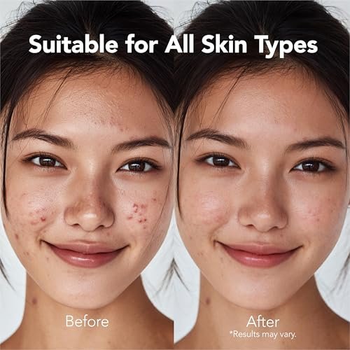 Saplaya K-Beauty Acne Care Hydrocolloid Patches - 100% Hydrocolloid Acne Spot Healing Patch for Pimple Care - görsel 14