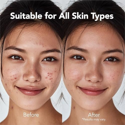 Saplaya K-Beauty Acne Care Hydrocolloid Patches - 100% Hydrocolloid Acne Spot Healing Patch for Pimple Care