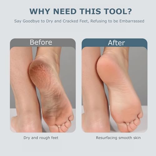 Upgraded Electric Foot Callus Remover – Portable Rechargeable Foot File with 3 Heads for Dry, Cracked Feet Avelisse
