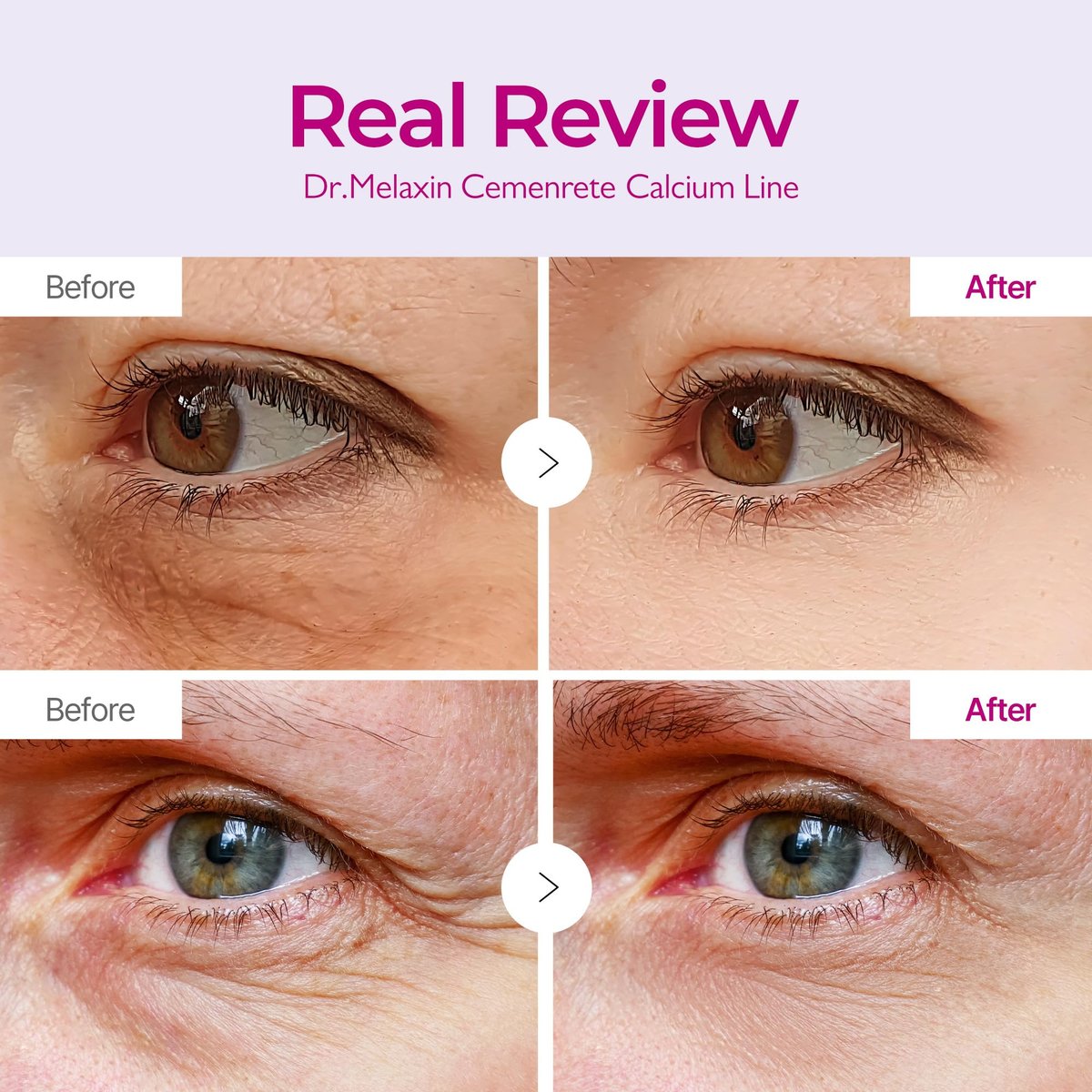 Dr.Melaxin Cemenrete Calcium Volume Eye Patches – 60 Patches for Sagging Skin, Wrinkles, Puffy Eyes & Dark Circles Avelisse