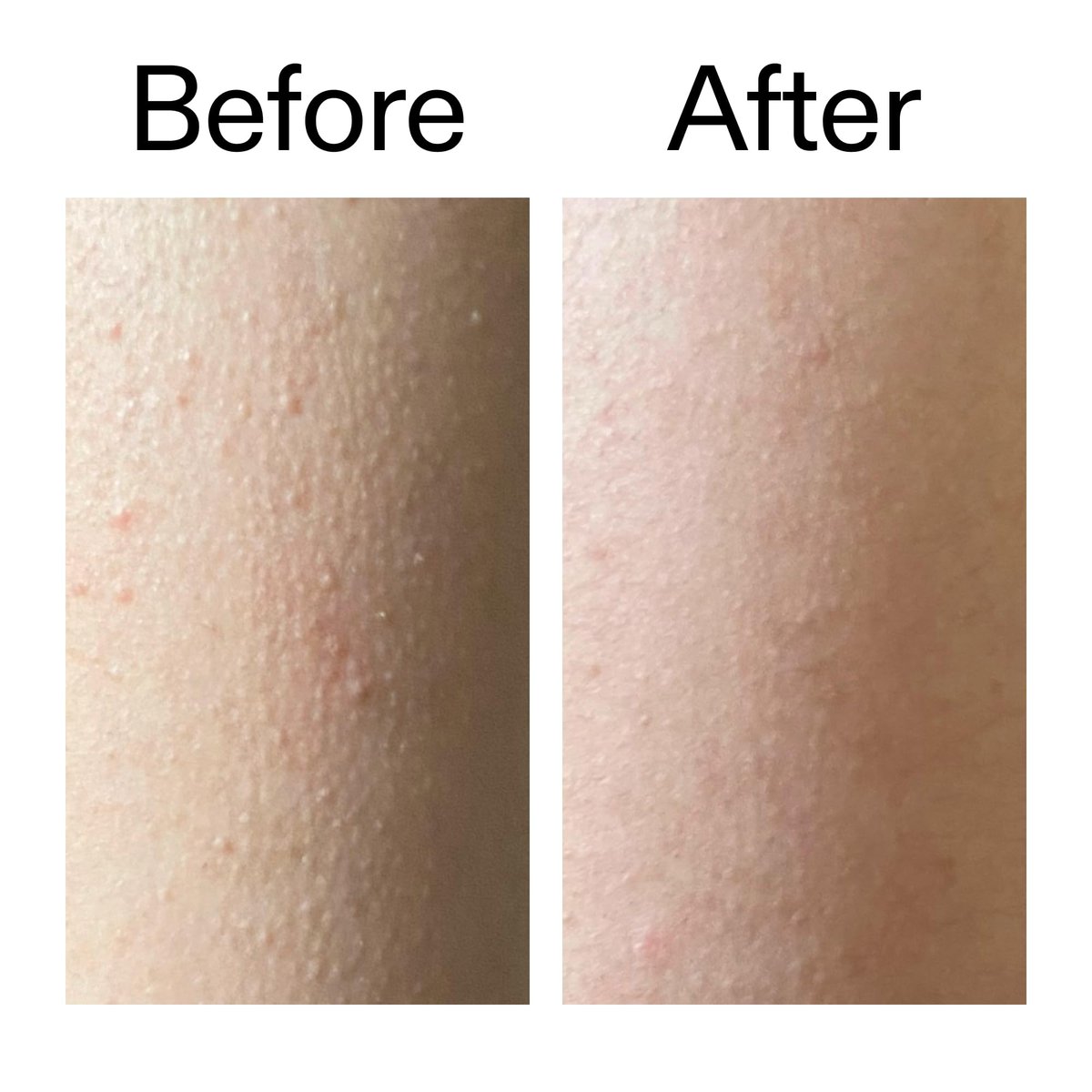 The INKEY List Glycolic Acid Exfoliating Body Stick – Deep Exfoliation for Rough, Bumpy Skin, Targets KP & Ingrown Hairs, Fragrance Free - görsel 13