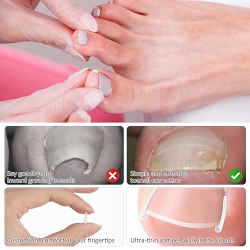 50+1 Ingrown Toenail Corrector Treatment Set - Professional Pain-Free Removal Kit with Toenail Lifter and Straightener Strips for Men and Women - görsel 5