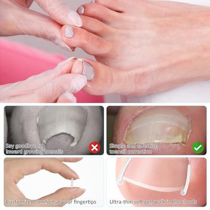 50+1 Ingrown Toenail Corrector Treatment Set - Professional Pain-Free Removal Kit with Toenail Lifter and Straightener Strips for Men and Women
