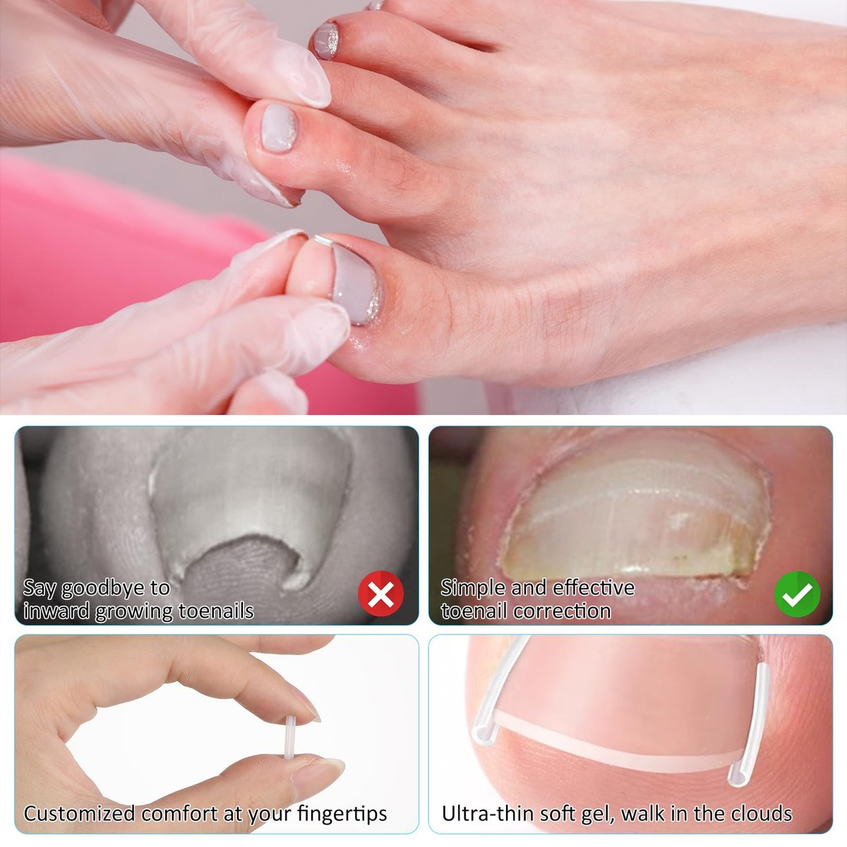 50+1 Ingrown Toenail Corrector Treatment Set - Professional Pain-Free Removal Kit with Toenail Lifter and Straightener Strips for Men and Women - görsel 6