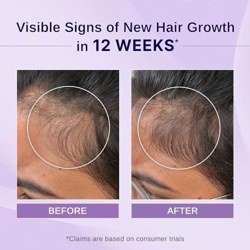 Bare Anatomy Nature x Science Rosemary Hibiscus Hair Growth Oil for Women & Men - Helps Hair Growth & Strengthens Hair, Nourishes Scalp & Controls Hair Fall, Suitable for All Hair Types - 100ml - görsel 4
