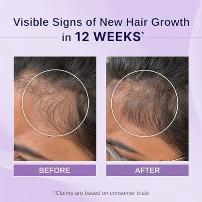 Bare Anatomy Nature x Science Rosemary Hibiscus Hair Growth Oil for Women & Men - Helps Hair Growth & Strengthens Hair, Nourishes Scalp & Controls Hair Fall, Suitable for All Hair Types - 100ml